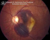 Subretinal hemorrhage. The area of hypofluorescence in the fluorescein angiogram is consistent with blockage of normal choroidal filling. Retinal vascular filling appears normal.